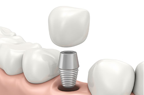 Eat Like Normal When You Have a Dental Implant