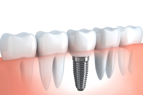 Be Thankful To Get Dental Implants