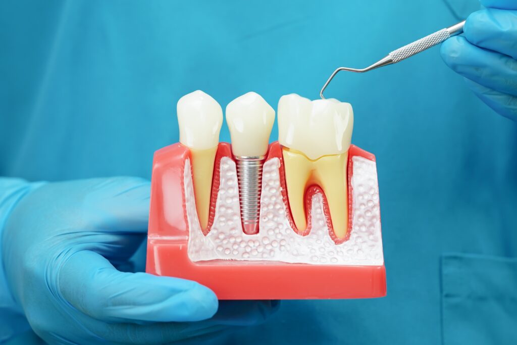 Dental Implants McKinney