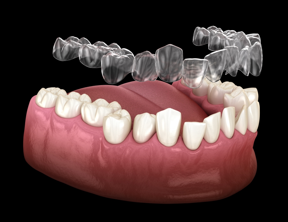 Clear Aligners Hurst