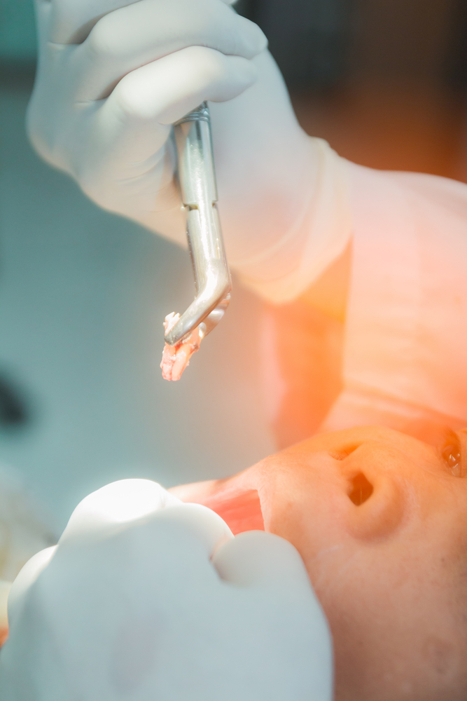 Tooth Extractions McKinney