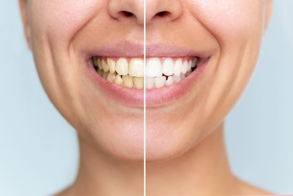 Teeth Whitening McKinney