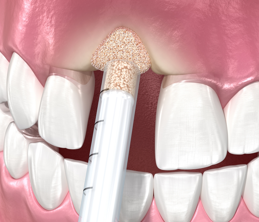 Bone Grafting Hurst